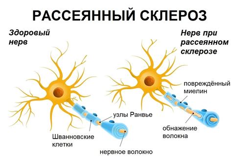 рассеянный склероз передается по наследству|Рассеянный склероз – что это, причины,。